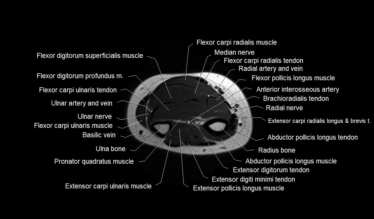 MRI 3T forearm axial cross sectional anatomy image 37.webp